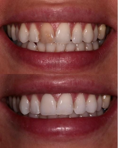 Smile Makeover Smile Makeover Treatment